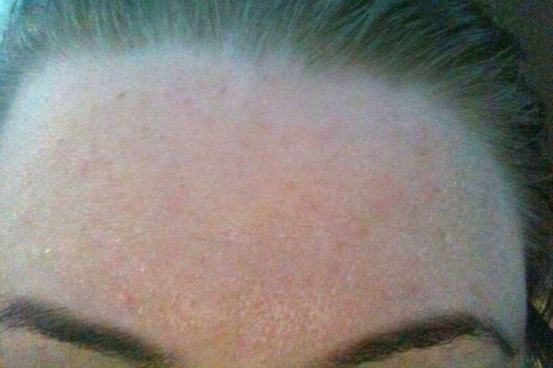 Forehead