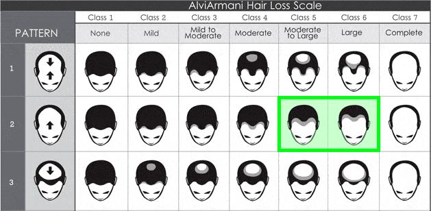Male Pattern Hair Loss Scale